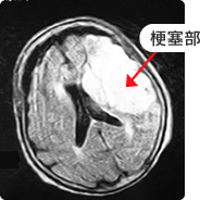 【写真】MRI画像